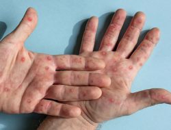 Kota Bandung Waspadai Monkeypox, Ini Gejala dan Pencegahannya