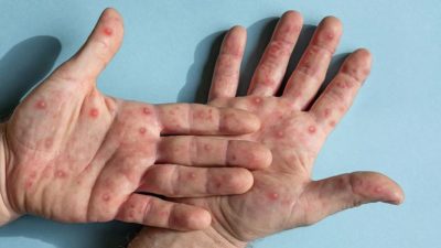 Kota Bandung Waspadai Monkeypox, Ini Gejala dan Pencegahannya