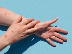 Pemda Jawa Barat Ambil Langkah Preventif Terkait Kasus Monkeypox