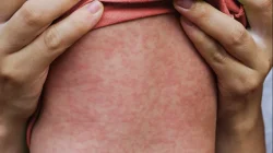 Kemenkes Ingatkan Bahaya Campak Jelang Lebaran, Jangan Sembarangan Sentuh Bayi