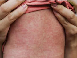 Kemenkes Ingatkan Bahaya Campak Jelang Lebaran, Jangan Sembarangan Sentuh Bayi